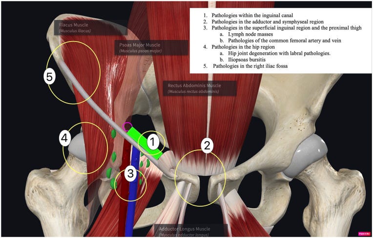 Hernias parte I.jpg